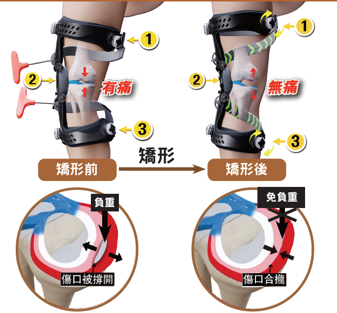半月板